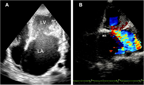 Figure 1 AP4 view. (A) Shows the main feature of EMF: apical and left ventricular outflow tract fibrosis, huge left atrium and left ventricular cavity obliteration. (B) Shows the mitral valve regurgitation (MR).