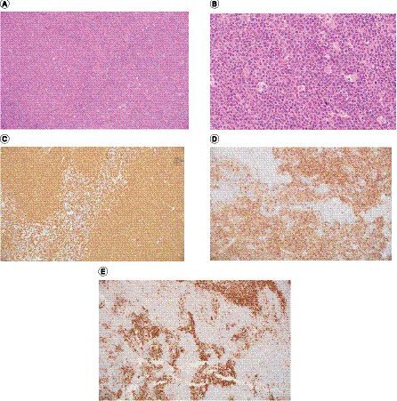 Figure 1 Microscopic features of pediatric-type follicular lymphoma.(A) Fully effaced lymph node architecture by large expansile follicles. (B) Follicles composed of monotonous intermediate-sized atypical lymphoid cells with blastoid appearance and starry sky pattern. (C) CD20 stain. Closely packed follicles. (D) Strongly expressed CD10 highlighting serpiginous follicles. (E) Negative BCL2 expression in the neoplastic follicles.