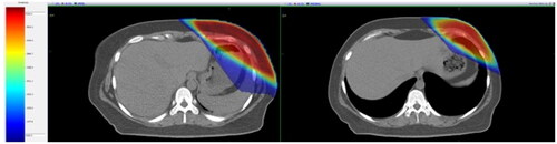Figure 2. Isodose distribution from the same level of the same patient calculated in FB CT (left panel) and DIBH CT (right panel) images.
