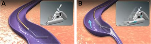 Figure 2 (A) Device inside the vein. (B) Mechanism action of action (Wire rotating and sclerosant injection).