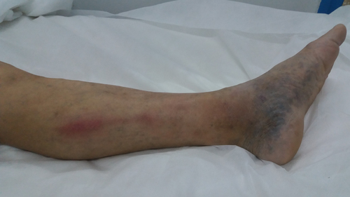 Figure 2 Superficial venous thrombosis on the left calf.