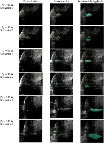 Figure 5. Ultrasound B-mode images captured at various acoustic power levels (80, 90, and 100W) during FUS sonication. Each image set demonstrates pre- and post-FUS sonication B-mode images, as well as AI-labeled B-mode images indicating the ablated area. Two rows of images represent two consecutive FUS sonication events; the top row corresponds to the initial 15−s FUS sonication, and the bottom row corresponds to the subsequent 15−s sonication. The second sonication took place 0.5 cm away from the ablated region created by the first sonication, following a 30-s cooling period.