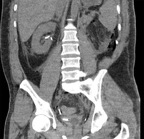 Figure 6 A coronal section from a non-contrast abdominal CT showing an appropriately positioned right sided ureteric stent without hydronephrosis.