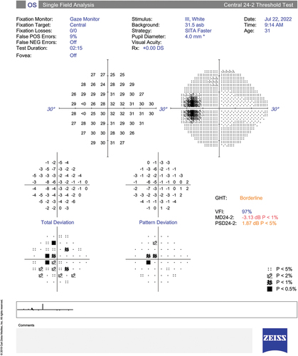 Figure 3. Left eye central 24–2 Threshold visual field test displaying an enlarged blindspot and a reduction in the centrocecal threshold values.