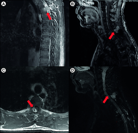 Figure 1. Magnetic resonance imaging of the spine.(A) Post-contrast T1-weighted sagittal image of initial tumor. (B) T1 Dixon sagittal image of recurrent tumor (12 years later) with extramedullary extradural soft tissue mass between C7 and T1. (C) Post-contrast T1-weighted axial image of initial tumor. (D) STIR sagittal image of recurrent tumor.