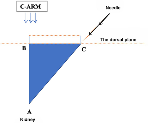 Figure 3 The way of puncture according to the principle of square triangles (A): location of targeted stones; (B): is the projection of A on the dorsal plane when the C-arm is perpendicular to this plane; (C): needle entry point.