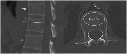 Figure 1. Example of CT attenuation value measurement.The first non-rib-bearing vertebra was designated as L1. In the sagittal view of CT, the measurement area was chosen between the midline zone and the superior endplate. An ovoid ROI was positioned on the anterior two-thirds of the vertebra, taking care to include the trabecular bone while avoiding the venous sinus and focal abnormalities.