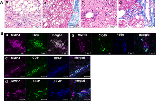 Figure 2 Identification of MMP-1-positive cells in advanced stage of NASH livers. (A) H&E staining (a and c) and Azan-Mallory staining (b and d) of liver tissues from representative advanced-stage NASH patients. Scale bar, 100 μm. (B) Confocal laser-scanning microscopy showing co-expression of MMP-1 and the indicated cell markers. Scale bars, 100 μm in a, and 50 μm in b to d.