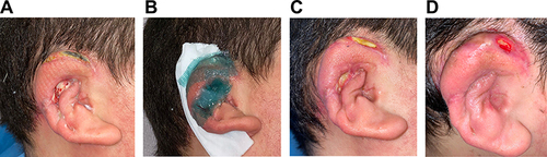 Figure 2 Clinical example of ear reconstruction.