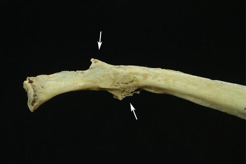 Figure 2. Sequelae of fracture in the 10th left costal arch (white arrows).
