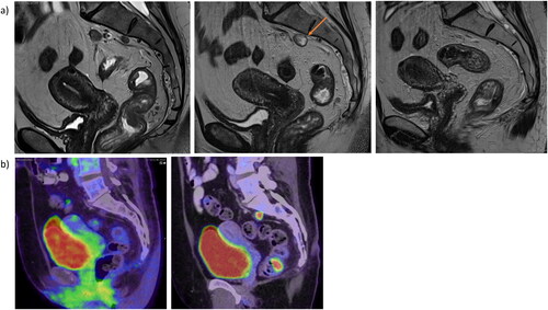 Figure 2. Case 2. a) MRI pre-treatment (left), after three months of treatment (middle) and post radiotherapy and immunotherapy. Suspected progression of the presacral lymph node is marked with an arrow. b) PET-CT scans after 3 months of treatment (left) and after 6 months post-treatment (right).