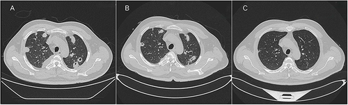 Figure 1 (A) Chest CT upon admission reveals scattered nodules and encapsulated pleural effusion in both lungs. (B) After a 10-day course of oral ceftriaxone and metronidazole, chest CT indicates a partial reduction of the pulmonary lesions. (C) Subsequent chest CT at 12 weeks post-antibiotic treatment, demonstrating significant and sustained regression of pulmonary lesions.