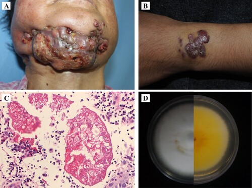 Figure 1. (A, B) Clinical presentations of case 1 and case 2. (C) Histopathological examination showing hyphal elements with Splendore-Hoeppli phenomenon. (D) Fungal culture showing a white and downy colony.