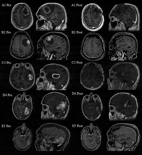 Figure 1. Pre- and postoperative post-contrast T1-weighted MRI scans in the axial and sagittal plane in patients A1, B2, C3, D4 and E5. Pre = preoperative. Post = postoperative