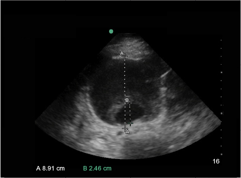 Figure 3 Ultrasound of an AAA in the axial plane.