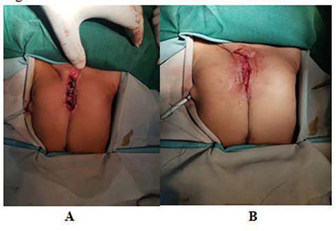 Figure 4 Immediately postprocedure: (A) approximation of sternal bars and muscle flaps done; (B) complication of inward chest retraction is not seen.