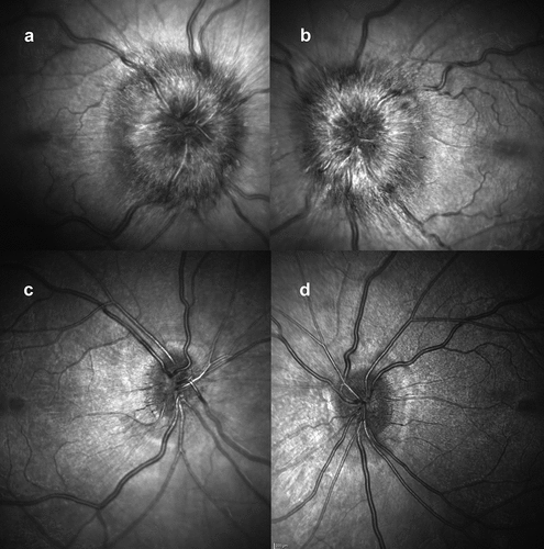 Figure 1. Optical coherence tomography (OCT) infrared images of the optic nerves at presentation: (a) right eye; (b) left eye, both showing papilloedema. OCT infra-red images at 2 months, following treatment: (c) right eye; (d) left eye, both without papilloedema.
