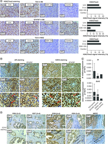 Figure 3. EZH2 is expressed in murine and human prostate cancer lesions.(A) Pictures show immunohistochemistry for H3K27me3 in T23 and ST4787 tumors collected from the experiments reported in Figure 2A, B and E. Histograms report staining intensity quantification, evaluated with ImageJ software. (B) Immunohistochemistry for AR and EZH2 on subcutaneously T23 and ST4787 lesions. Scale bars indicate magnifications. The lower panels are digital magnifications of selected areas indicated by a dotted line in the middle panels; red and black arrows indicate selected tumor and stromal cells, respectively (C). Real time PCR for Ar and Ezh2 on RNA samples collected from whole T23 and ST4787 tumors and from CD45+ cells FACS sorted from T23 tumors (n = 2). (D) Immunohistochemistry for EZH2 on human prostate cancer lesions with different Gleason Score. Scale bars indicate magnifications. Black arrows indicate stromal cells.