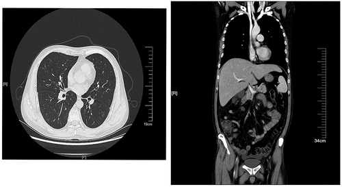 Figure 1. A CT scan of chest and abdomen on the day of admission. A mild inflammation was seen in the lower lobes of bilateral lungs, and the liver was slightly enlarged.