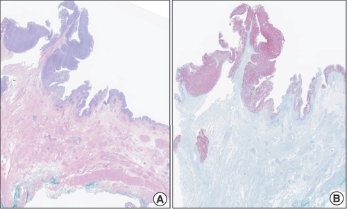 Figure 5. Robotic-assisted laparascopic cystourethrectomy of urinary bladder showing melanoma in situ. (A & B) Robotic-assisted laparoscopic radical cystourethrectomy showing primary malignant melanoma of the urinary bladder with melanoma in-situ (left), specimen stains positive for SOX 10 (right).
