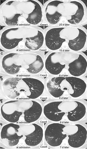 Figure 1 Chlamydia psittaci appearance on chest CT in Cases 1–6 (A–F) on the day of admission (left) and after treatment (right).