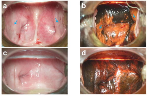 Figure 2. Endoscopic images of patients with vaginal stump VaIN I before and after treatment are presented in Figure 2. (a) Shows the appearance of the lesion site before treatment when 3% glacial acetic acid was applied. (b) Displays the lesion site before treatment when Lugol’s iodine solution was applied for recurrent staining. After half a year’s reexamination following treatment, (c) exhibits the lesion site when 3% glacial acetic acid was applied. Finally, (d) demonstrates the lesion site after half a year’s reexamination following treatment when Lugol’s iodine solution was applied. The blue arrow indicates the location of the lesion in the images.