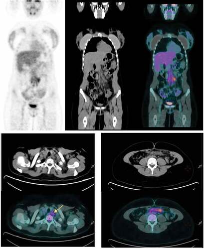 Figure 1. (a) Surveillance FDG PET/CT performed 3 d after the first dose of the Oxford-AstraZeneca COVID-19 vaccine shows FDG avidity in abdominal lymph nodes. (b) Increased FDG uptake in left lower cervical lymph nodes (SUVmax 3.5 g/ml). (c) Subcentimetric mesenteric lymph nodes with moderate FDG uptake 3 d (SUV max 4.7 g/ml).