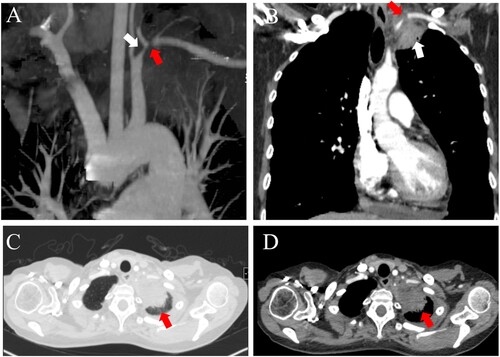 Figure 2. Contrast-enhanced CT showing a pulmonary mass in the left upper lobe invading the left subclavian artery. CT angiography (A) showing the left subclavian artery stenosis (white arrow) and occlusion (red arrow). CT image of the coronal view (B) showing a mass in the left apex of the lung (white arrow) extending into the left subclavian artery. CT images of the lung window (C) and soft tissue window (D) revealed patchy consolidation in the left apex of the lung (red arrow).