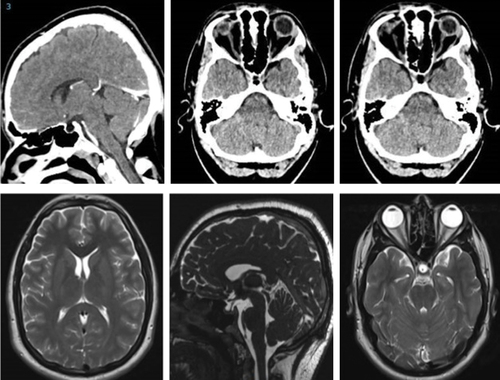 Figure 3. Computed tomography scans (upper row) and magnetic resonance imaging (lower row) showing a partially empty sella turcica and small ventricles, suggestive of intracranial hypertension.