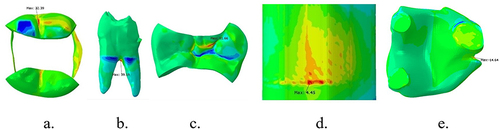 Figure 2 Stress distribution after vertical loading on lower first molar with MOD cavity and polyethylene fiber reinforced composite on (a) enamel, (b) dentin, (c) packable composite, (d) polyethylene fiber wallpapering the cavity wall, and (e) polyethylene fiber wallpapering the cavity floor.