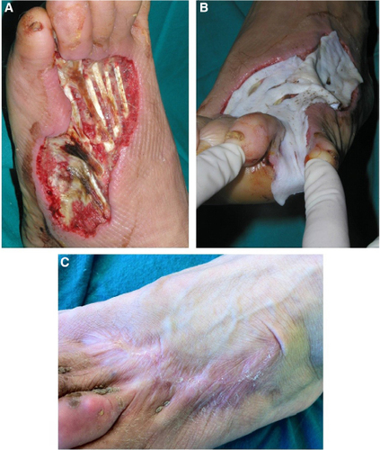 Figure 13 Coverage of tendons exposure and dermal component reconstruction in a deep traumatic wound by glycerolized dermis. Wound appearance after adequate debridement (A), application of glycerolized DED (B), and final re-epithelization after 2 months (C).