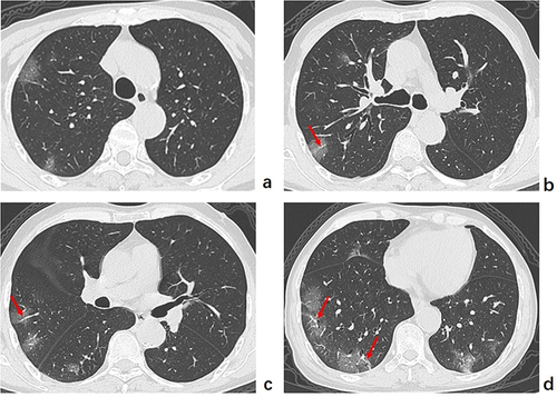 Figure 2 Typical chest computed tomography manifestations of a 67-year-old man infected with the Omicron variant. (a–d) Axial computed tomography images show round-like and patchy ground-glass opacity in the peripheral areas of both lungs accompanied by vascular enlargement patterns (red arrow).