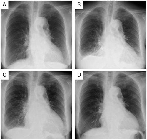 Figure 1. Chest radiographic findings in our present case.Chest radiographs in the outpatient clinic (A), on admission (B), after treatment of heart failure with diuretics (C), and two weeks after the initiation of high-dose PSL therapy (D).