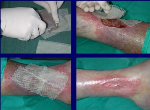 Figure 9 Treatment of a leg ulcer wound with cryopreserved unmeshed skin allografts.