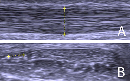 Figure 1 (A and B) Grey scale ultrasound pictures. (A) Longitudinal view showing a normal 4.5 mm thick Achilles tendon midportion. (B) Cross view showing a plantaris tendon (marked) localised close to the medial side of a normal Achilles tendon midportion.