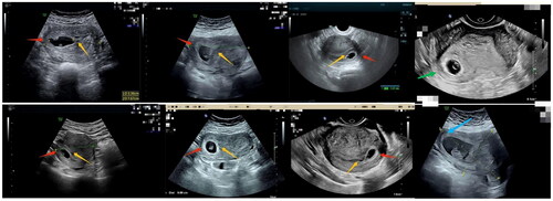 Figure 1. Red arrow showed the gestational sac in lateral upper angle of uterine cavity and yellow arrow showed the endometrium line sign extending from the gestational sac to the endometrial cavity. Green arrow showed the myometrial thickness from the gestational sac to the outer border of the uterus. Blue arrow showed the longitudinal images of the implantation.