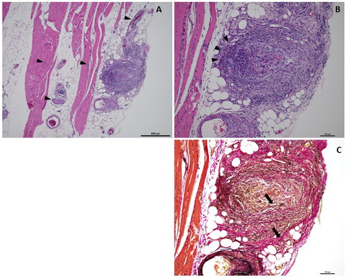 Figure 3. Histopathological findings of the left gastrocnemius muscle. Hematoxylin-Eosin staining shows an inflammatory cell infiltrate, including lymphocytes and neutrophils (A, B: arrowheads), and in some cases, neutrophils are clustered. Elastica Van Gieson staining reveals scattered fragmented elastic fibres (C: arrows).