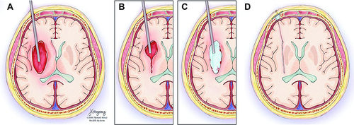 Figure 17 Stereotactic Intracerebral Hemorrhage Underwater Blood Aspiration (SCUBA) technique. (A) The cannula is inserted distally to the hematoma under stereotactic navigation. (B) Blood of the hematoma is aspirated as brain tissue closes in around the tip whereupon the cannula is retracted a few centimeters. (C) Subsequently, the surgeon infuses saline through the cannula, filling the cavity. (D) The saline is evacuated, and the cannula is fully retracted; intraoperative ultrasound and DYNA CT images are acquired to confirm the hematoma removal. Copyright © 2018. BMJ. Reproduced with permission from Kellner CP, Chartrain AG, Nistal DA, et al. The stereotactic intracerebral hemorrhage underwater blood aspiration (SCUBA) technique for minimally invasive endoscopic intracerebral hemorrhage evacuation. J Neurointerv Surg. 2018;10(8):771–776.84