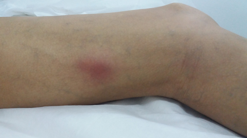 Figure 1 Superficial venous thrombosis on the left thigh.