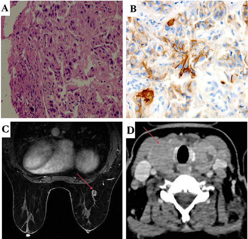 Figure 1 (A) HE staining of the thyroid mass showed invasive ductal carcinoma of mammary origin. (B) IHC examination revealed the thyroid mass was positive for PD-L1.(C) Breast MR showed a right breast nodule (red arrow), BI-RADS category 4 (1.1cm x 0.8cm x 0.8cm). (D) CT of the neck, chest and abdomen showed primary breast cancer with thyroid metastases (red arrow meant metastatic lesion).