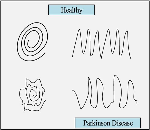 Figure 7. Healthy vs. PD disease prediction.