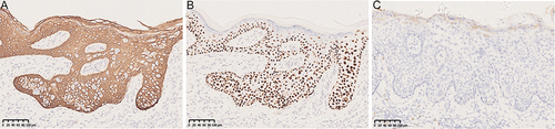 Figure 2 Immunohistochemical stain: We highlight the immunohistochemical staining of case 3. CK5/6 was positive for intact membrane, P63 was positive for nucleation, and CEA was negative. (A) CK5/6+ (200X), (B) P63+ (200X), (C) CEA- (200X).
