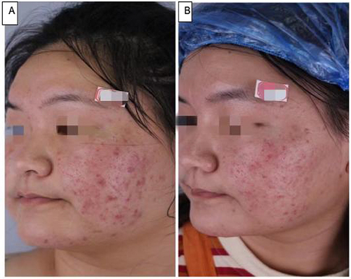 Figure 3 A 20-year-old female with PAE in the IPL 560/590 nm group: (A) before the treatment, (B) 1 month after the total treatment has finished, showing poor improvement in PAE (<25%).
