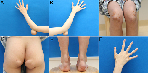 Figure 1 Multiple subcutaneous lesions over different locations. (A and B) lesions in both elbows. (C) lesions in both knees. (D) lesions in buttocks. (E) lesions in Achilles tendons. (F) lesions over proximal interphalangeal joints.
