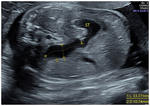Figure 1. Measurement of the length and maximum transverse diameters of the fetal dilated small duodenum by ultrasound.