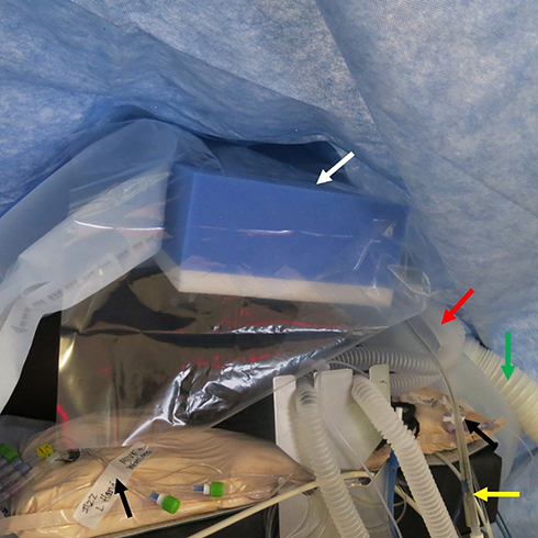 Figure 4 Intraoperative photograph showing the head of the bed. The patient’s head is covered with a foam pillow (white arrow) to prevent pressure from any of the surgical instruments or operating personnel. The anesthesia circuit (red arrow); orogastric tube (yellow arrow); Bair hugger tubing (green arrow); and peripheral intravenous infusions (black arrow) are labelled. The patient’s head is covered in plastic and an upper body Bair Hugger™ is placed to maintain normothermia.