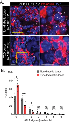 Figure 4. PDX1:SND1 interactions are negatively impacted in T2D human β cells. (a) Representative PDX1:SND1 PLA and proinsulin images acquired from human pancreatic tissue sections from non-diabetic donor (nPOD case #: 6020: 60 years old male, BMI = 29.8) and T2D donor (nPOD case#: 6297: 60 years old male, BMI = 29.5, 3 years T2D duration). (b) quantitation of PLA signals in each group stratified by number of PLA signals per β cell nuclei. The images to the right in (a) are magnified regions outlined in the yellow box above. (n = 4). ns, not significant; *, p < 0.05; **, p < 0.01. (scale bars = 10 μm).