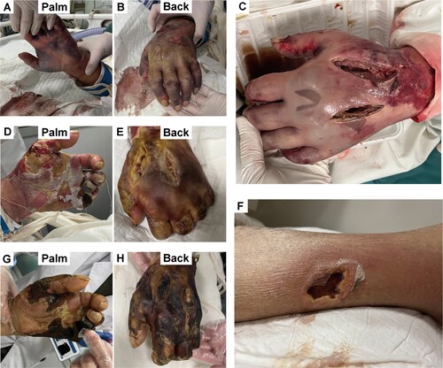 Figure 1. Changes of signs in the patient with severe Vibrio anguillaris infection. Three hours after admission, lesions of the left hand showed cyanosis, multiple blisters, and ecchymosis in the palm (A) and the back (B), with rupture of some large blisters. Three days after admission, debridement was performed with fascial compartment dissection for decompression (C). Ten days after admission, lesion of the left hand was deteriorated with the necrosis of the pinky finger (D and E). Fourteen days after admission, the left lower limb showed local lesion with local redness, partial ulceration, and bloody exudate (F). Twenty-six days after admission, necrosis of the left hand was uncontrolled (G and H).