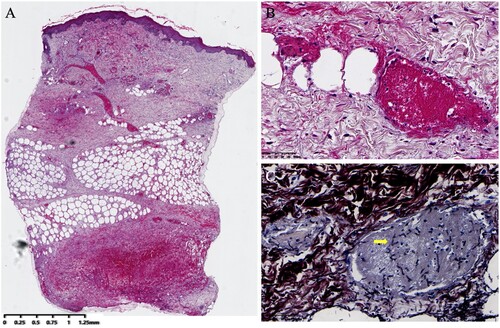 Figure 5. Histological examination of cutaneous Hormographiella aspergillata infection. A: Intravascular thrombosis in both dermal and subcutaneous vessels. (original magnification ×20, haematoxylin and eosin stain). B: Fibrin thrombus in the dermal blood vessels. (original magnification ×400, haematoxylin and eosin stain). C: Branched septate hyphae embedded in fibrin thrombi in the vessels (original magnification ×600, Grocott-Gomori methenamine silver stain).