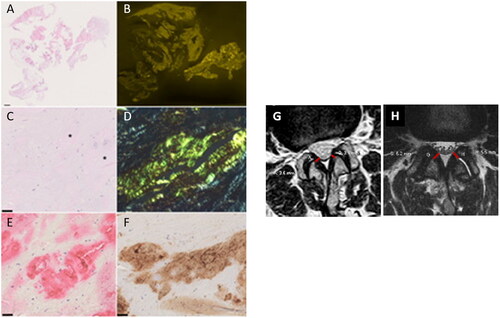 Figure 2. Histology of resection specimens showed fragments of soft tissue and ligamentum flavum (A). Variable amounts of amyloid were found in the ligamentum flavum (B). At higher magnification, a homogenous eosinophilic material was noted after haematoxylin and eosin staining (asterisk; C), which showed a typical yellow-green birefringence in polarized light after Congo red staining (D). These deposits immunoreacted with antibodies directed against transthyretin (E) and complement 9 (F). Haematoxylin and eosin staining (A, C); Congo red staining viewed in fluorescence microscopy (B); Congo red staining viewed in polarization microscopy (D), anti-transthyretin-immunostaining (E); anti-complement 9-immunostaining (F). Barr denotes 1 mm (A) and 50 µm (C, E, F). Original magnifications 0.56-fold (A, B); 200-fold (C–F). (G, H) Exemplary images of ligamentum flavum measurement on axial T2-weighted MR images (L2–L3 level), in a patient without (G) and with (H) proven amyloid deposition at histopathology. The corresponding measurements are given for each side in mm.